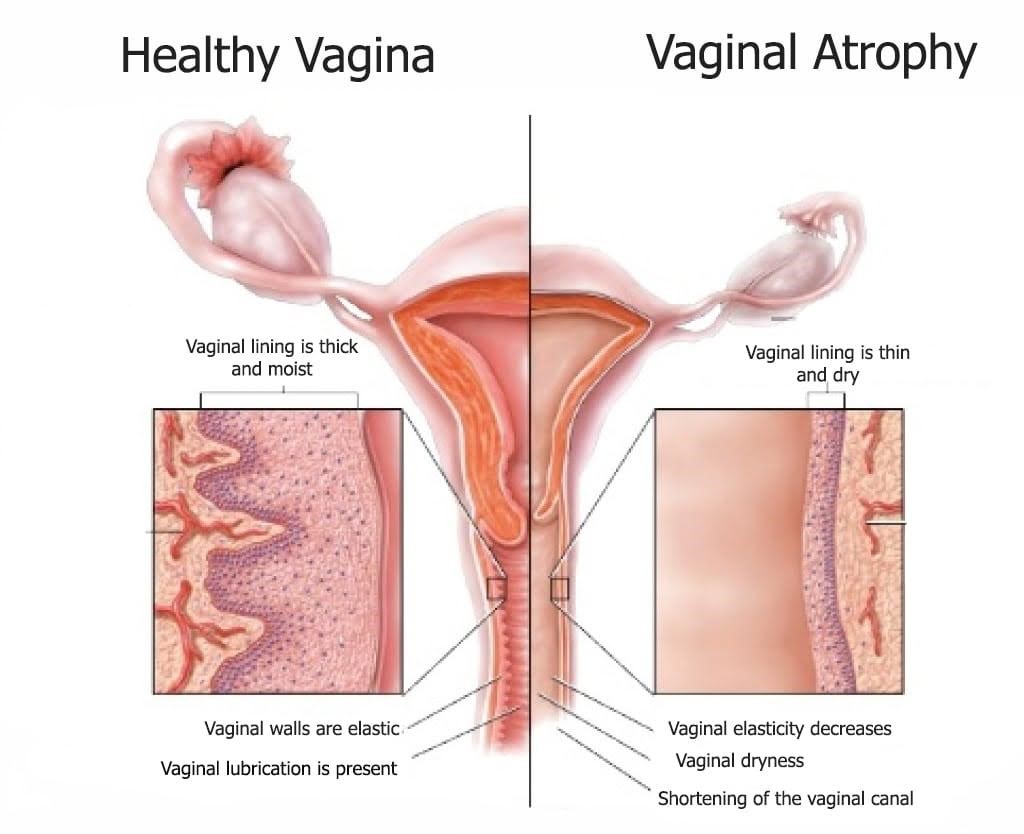 Vaginal atrophy vs normal vagina